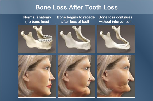 bone loss after tooth loss
