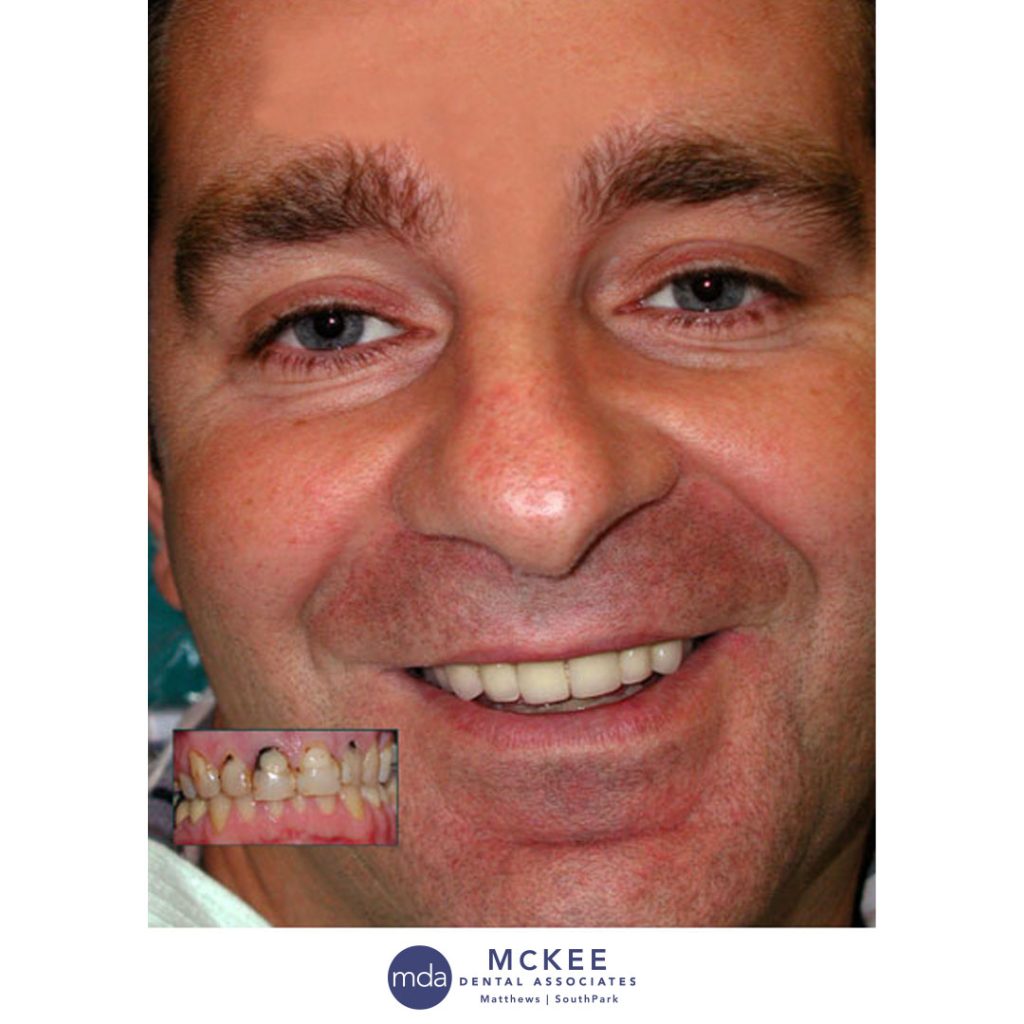 Restoring Severe Tooth Decay with Ceramic Crowns