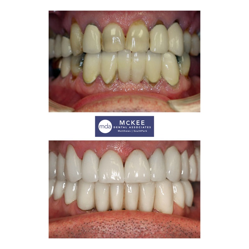 Full Dental Makeover with Implants