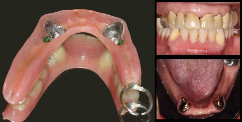 Lower Two Tooth Overdenture