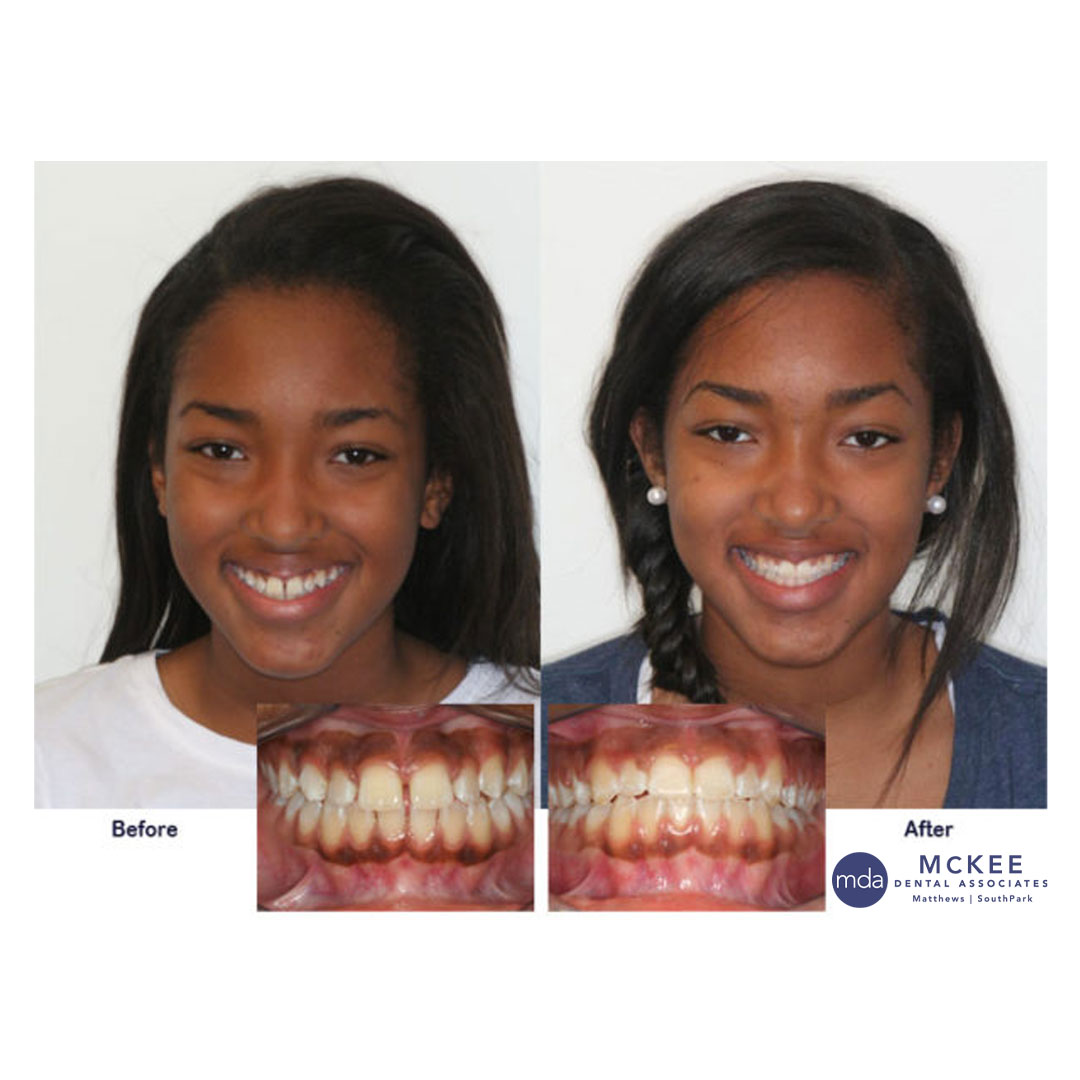 Braces To Straighten Teeth and Close Spaces
