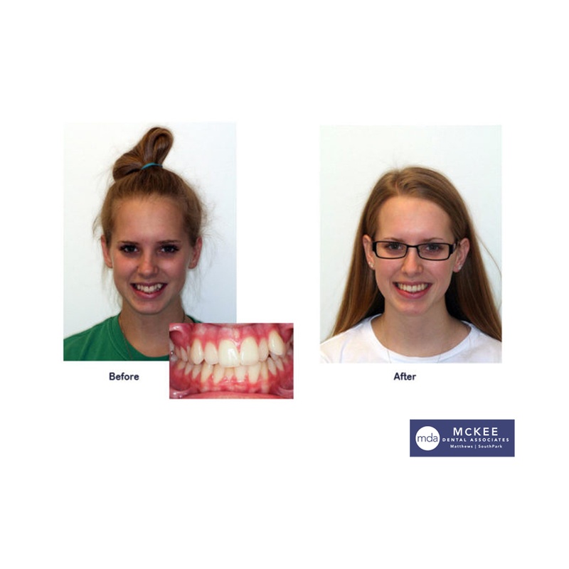 Braces To Fix Impacted Canines