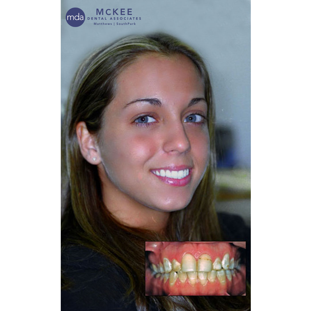 Dental Veneers Replace Bonding