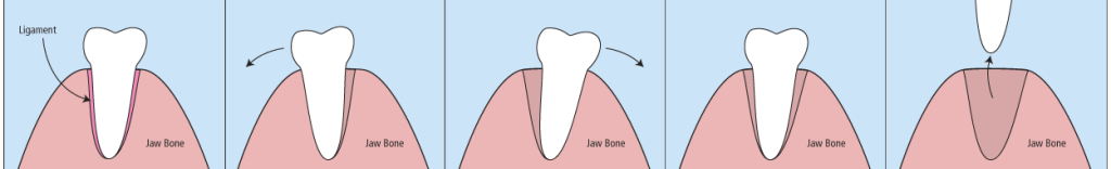 Extraction sequence 1