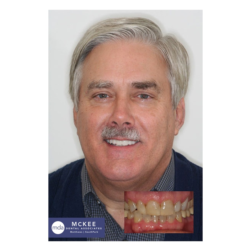 Full Mouth Reconstruction