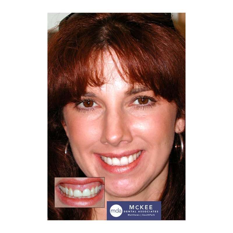 Gum Reshaping and Veneers