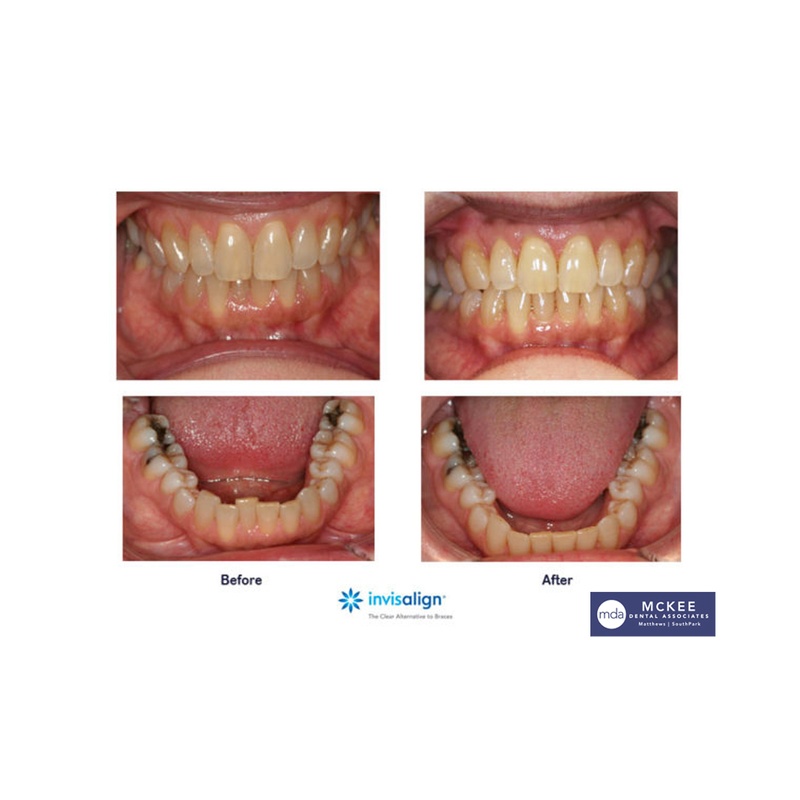 Invisalign Express for Minor Crowding