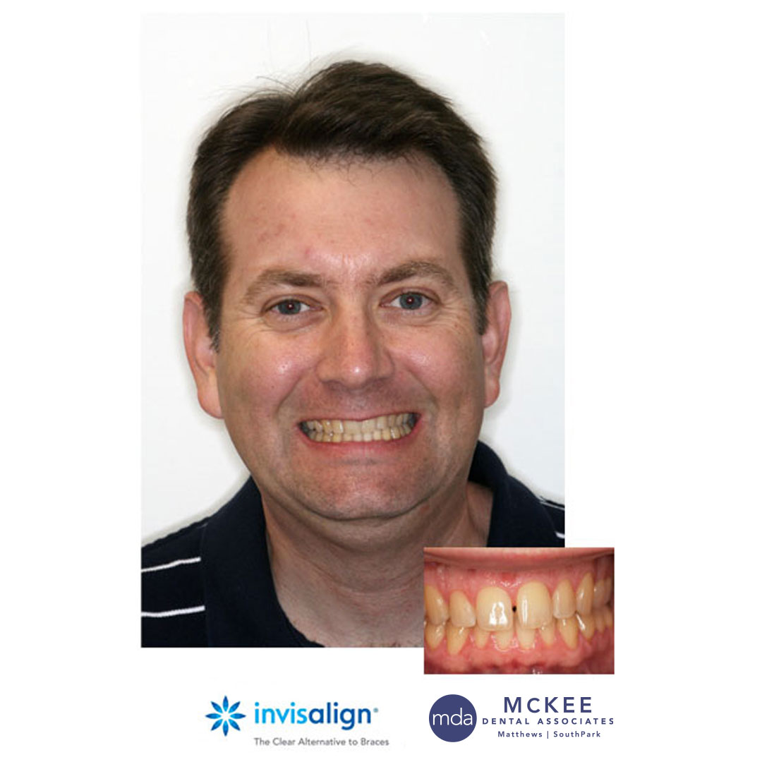 Invisalign Retainer To Close a Midline Gap