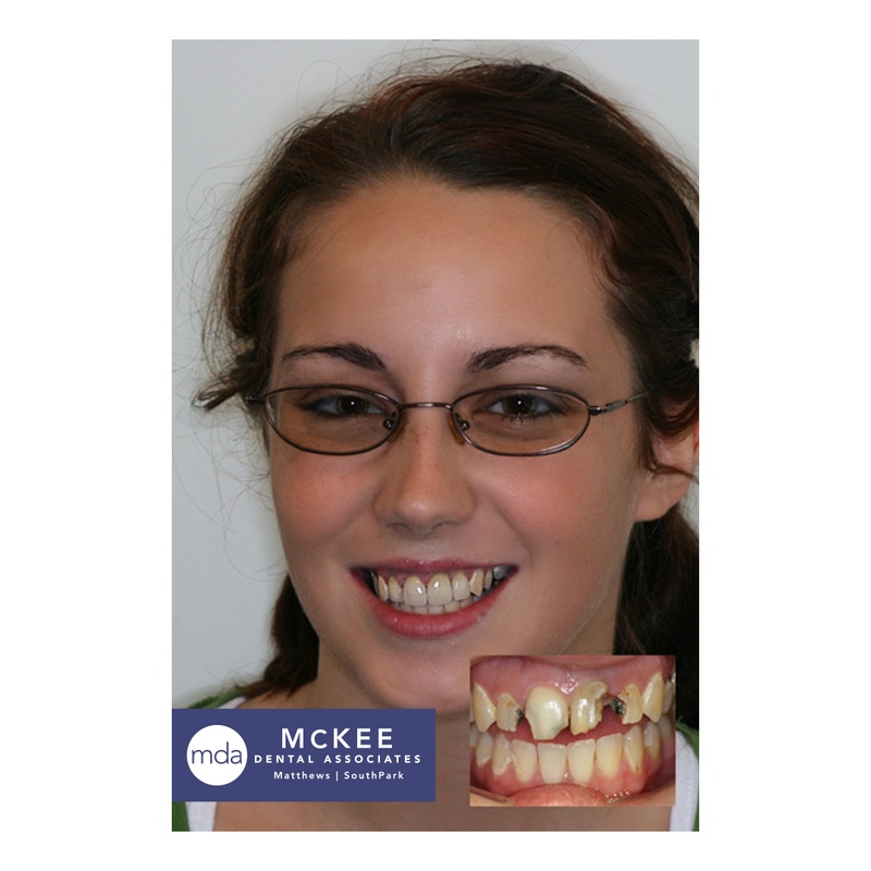 Rebuilding a Dental Smile