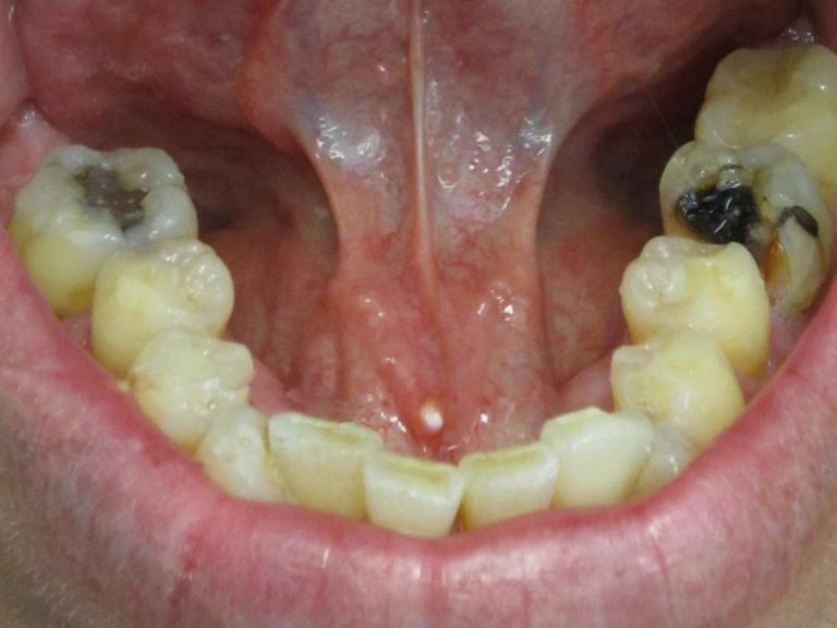 What to know about salivary stones