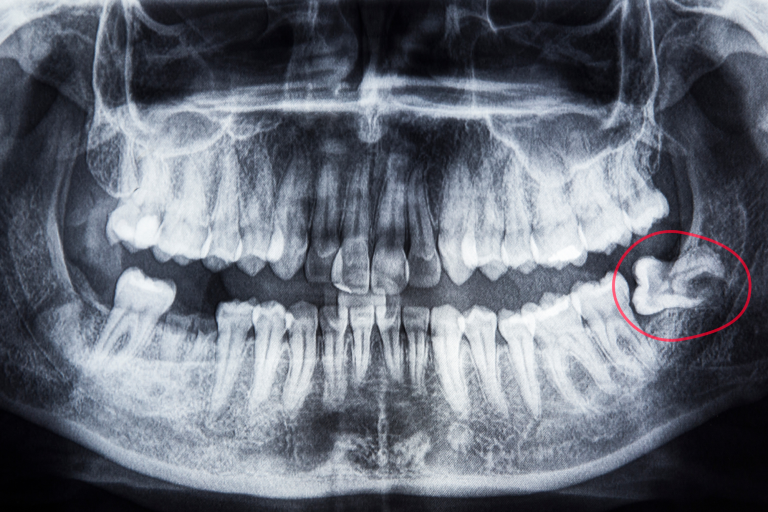 Wisdom Teeth Page Photos 768x512 1