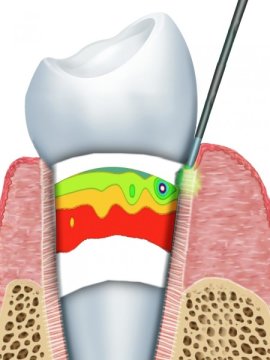 Benefits of laser treatments for dental problems