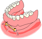 full arch implant bar