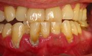 gum stage4 1