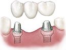 multi implant sup bridge