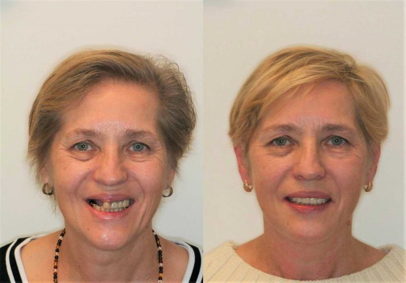 Combination Overdenture