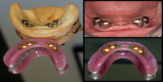 overdenture comp 002