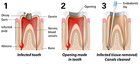 root canal stages 1 1
