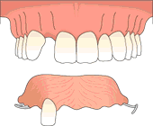 single implant partial