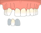 single implant rbr