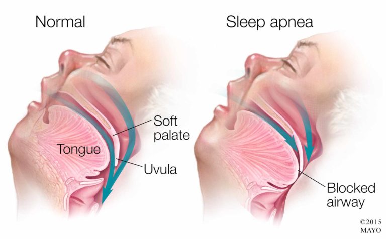 sleep apnea 768x476 1