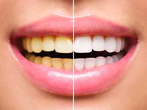 teeth whitening icon