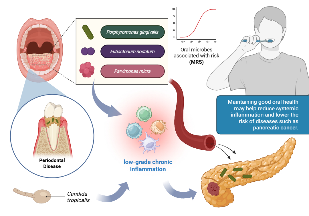 Can the tongue microbiome help diagnose pancreatic cancer